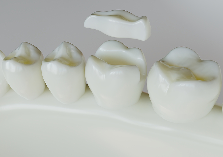 Ceramic Inlay Crown Over A Totth - 3d Rendering
