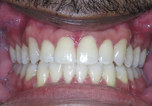 SureSmile® After