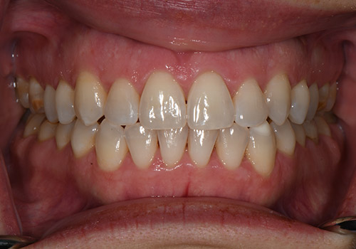 SureSmile® After