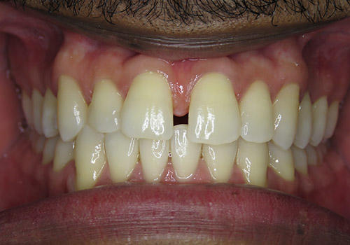 SureSmile® Before