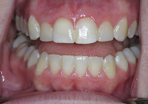 SureSmile, Composites, and Whitening After