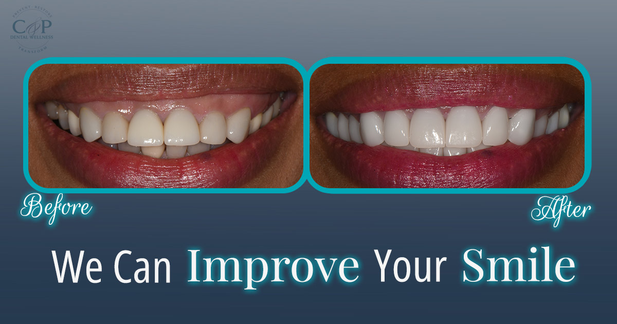 Dental Crowns